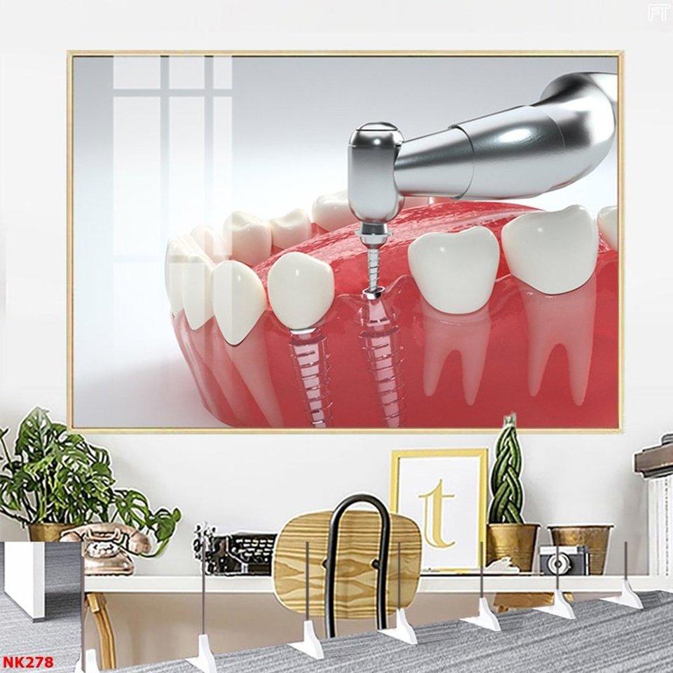 Tranh nha khoa kỹ thuật trồng răng sáng bóng nhờ chất liệu cao cấp